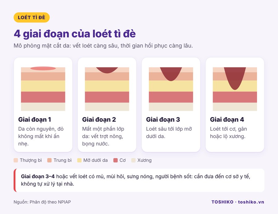 Minh hoạ 4 giai đoạn của loét tì đè qua mặt cắt da