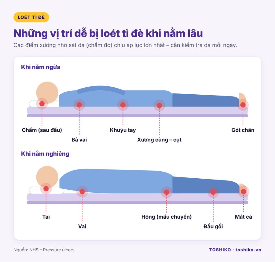 Vị trí dễ bị loét tì đè khi nằm ngửa và nằm nghiêng