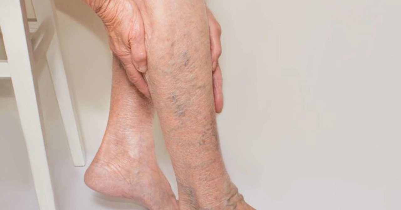 Người bị suy giãn tĩnh mạch có thể ngâm chân để xoa dịu triệu chứng