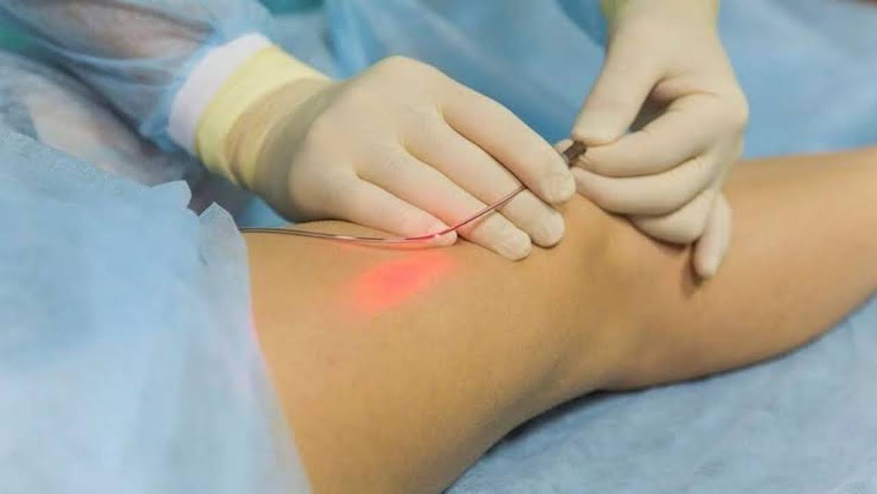Điều trị suy giãn tĩnh mạch bằng laser nội mạch
