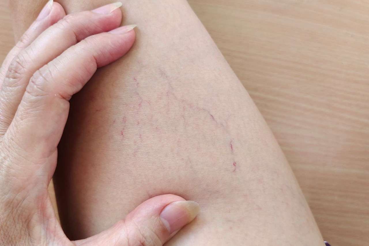 Thói quen ít vận động làm tăng nguy cơ bị giãn tĩnh mạch