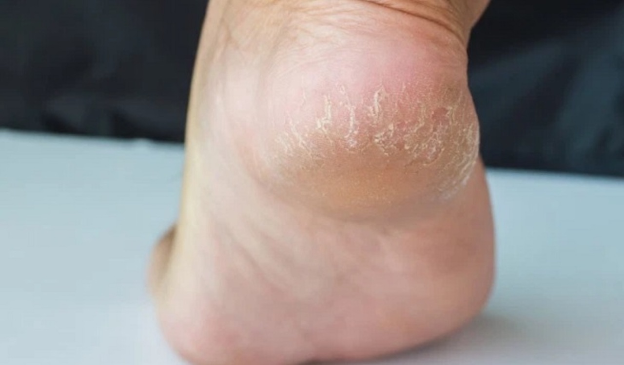 Ngâm chân giúp phòng ngừa một số bệnh lý ngoài da
