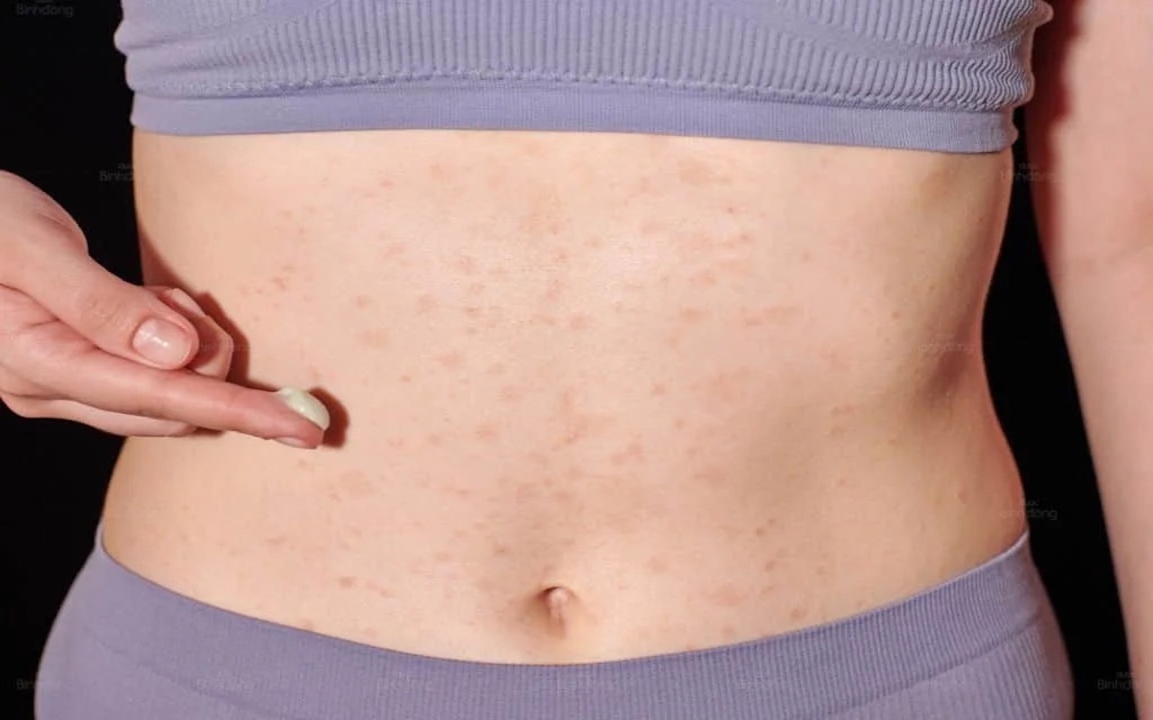 Không vệ sinh đai rung sạch sẽ có thể làm tăng nguy cơ nổi mẩn