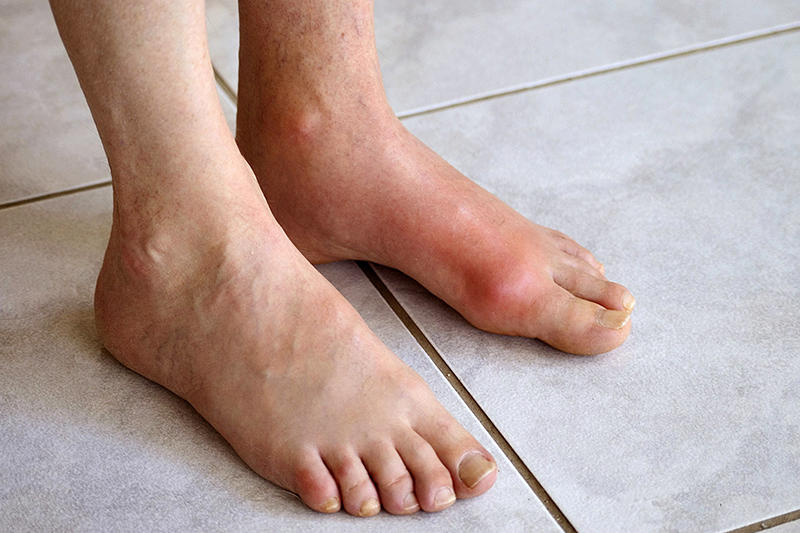 Đậu phụ “chất cấm” đối với bệnh nhân gout 